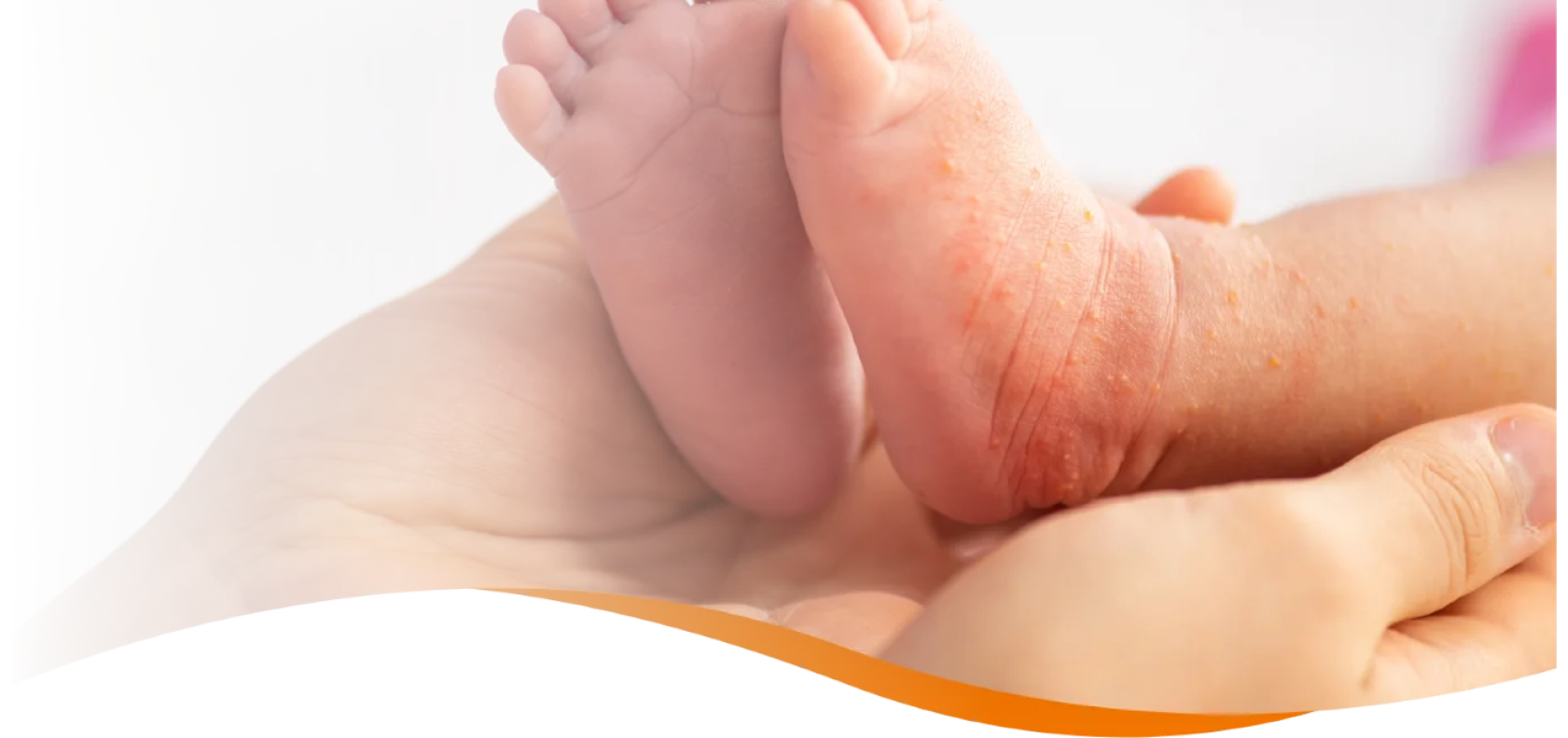 cmpa-symptoms-banner